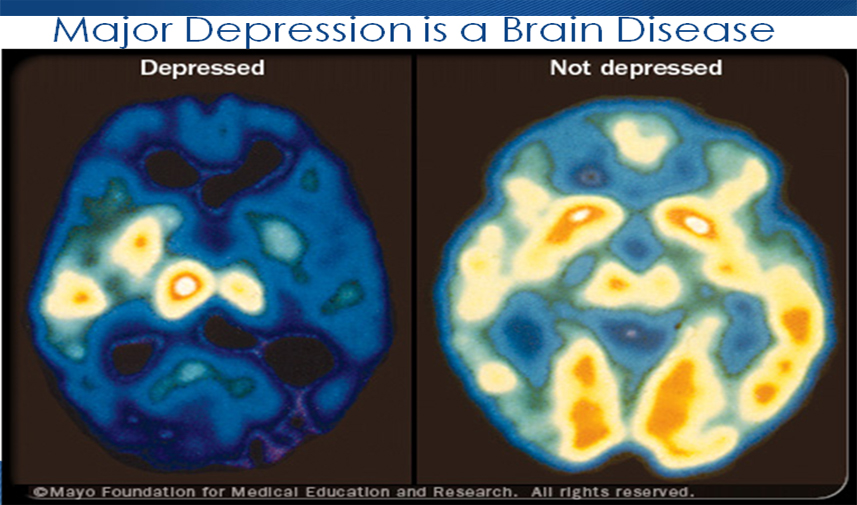 brain-chemistry-center-lakeland-florida-depression-treatment-polk